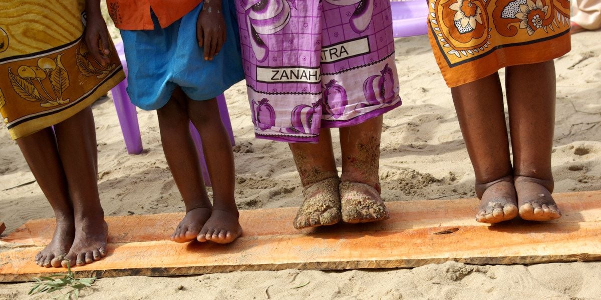 Beine und Füße von Kindern, die an Elephantitis erkrankt sind.