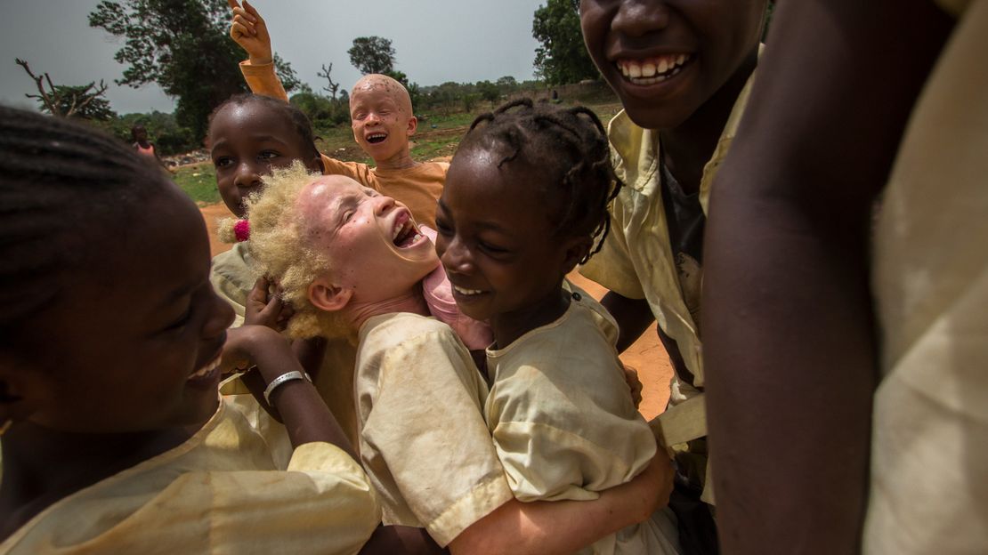 Die 10-jährige Aicha aus Guinea-Bissau hat Albinismus. Mit Unterstützung von HI kann sie wie andere Kinder zur Schule gehen