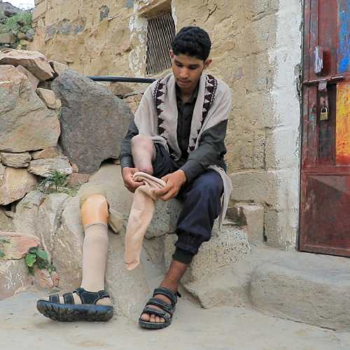Abdulaleem, Opfer einer Mine, legt seine Beinprothese an.