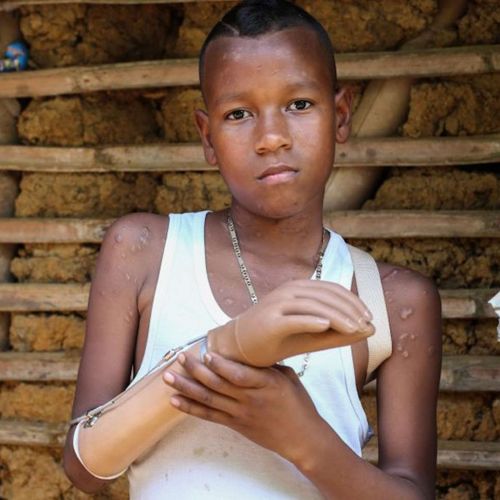 Ein etwa zwölfjähriger Junge aus Südamerika zeigt seinen prostethischen Arm