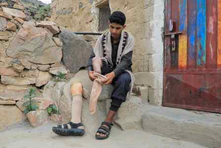 Junger Mann mit amputierten Bein sitzt vor seiner Hütte. 